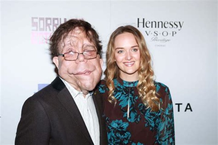 Understanding Adam Pearson's Height: A Comprehensive Guide