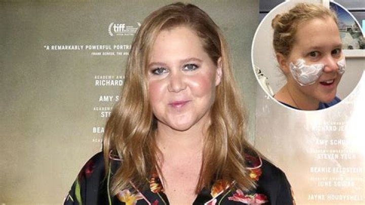 Amy Schumer Dissolves Fillers After Plastic Surgery Procedure: ‘I Looked Like Maleficent’