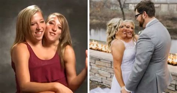 Are Abby and Brittany Hensel still conjoined?