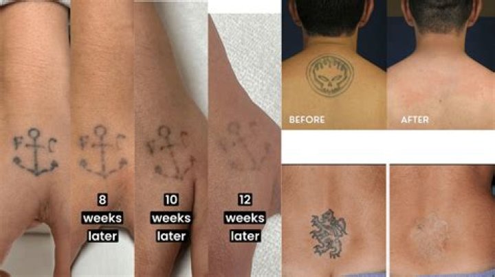 Chrisean Rock Books Laser Tattoo Removal Appointment For Blueface Ink