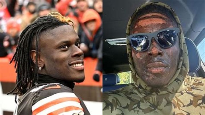 David Njoku Burned 17% Of His Body In September Accident
