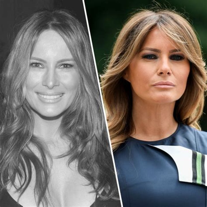Did Melania Trump Get Plastic Surgery? See Pics of Her Transformation!