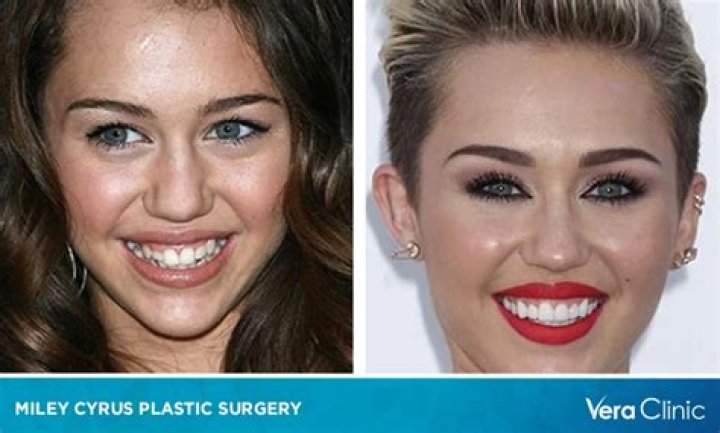Did Miley Cyrus Get Plastic Surgery? Read Everything She’s Said About Cosmetic Enhancements