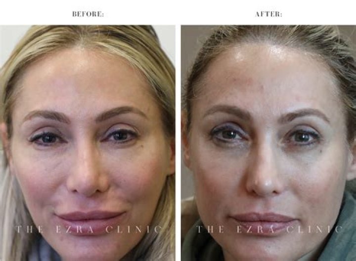 Kylie Jenner's Face Looks Different, Critics Blame "Long Term Filler Usage" For Adverse Aging Effects