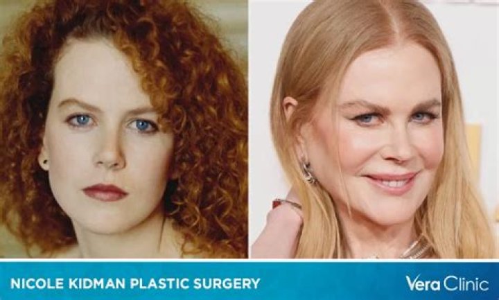 Nicole Kidman Sparks Plastic Surgery Rumors With Noticeably Swollen Face!