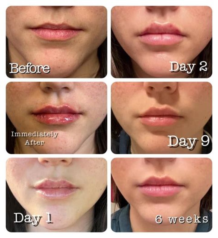 Plastic Surgery? Rumer Willis’ Latest Instagram Post Has Fans Wondering If She Got Lip Injections