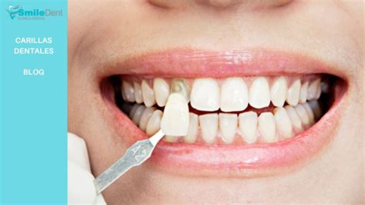 ¿Se pueden blanquear las carillas de composite? – Celebrity.fm