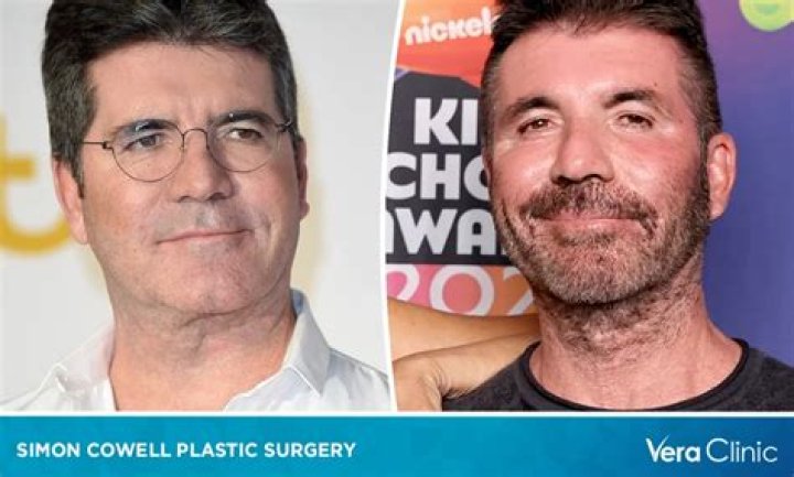 Simon Cowell Sparks Plastic Surgery Rumors on ‘AGT’ — Experts Weigh In (EXCLUSIVE)