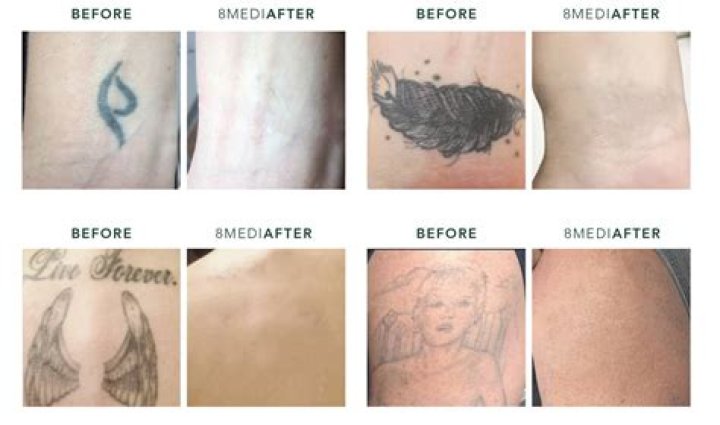 Skin Check-In With Dr. Will: 10 Things You Need to Know Before Getting a Tattoo Removed