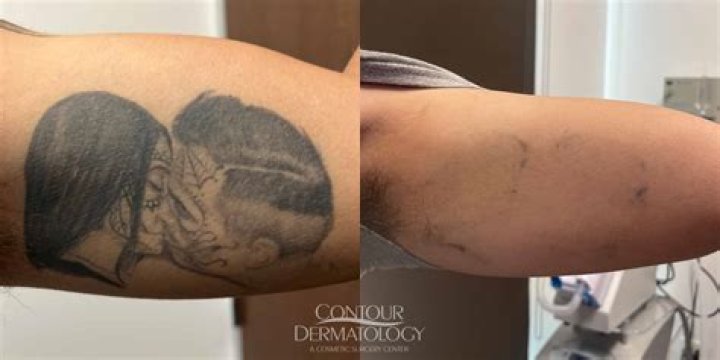 Student Left With Horrific Scar After Tattoo Removal Goes Painfully Wrong (WARNING: Graphic Images)