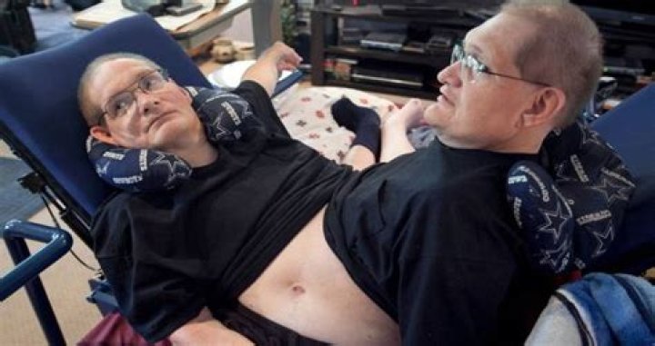 The Longest-Living Conjoined Twins In History