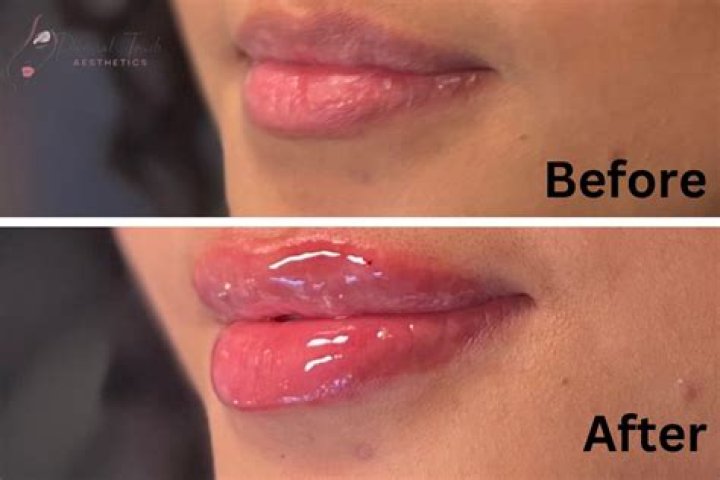 The Power of Cosmetic Enhancements! How Lip Fillers and Other Procedures Can Make You More ‘Confident’